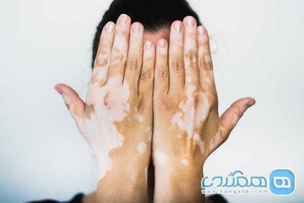 سلول درمانی، نسخه شفابخش لک و پیس