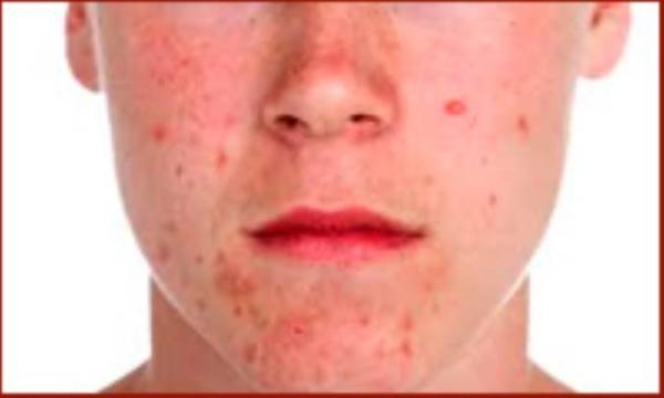 روغن های اساسی برای آکنه